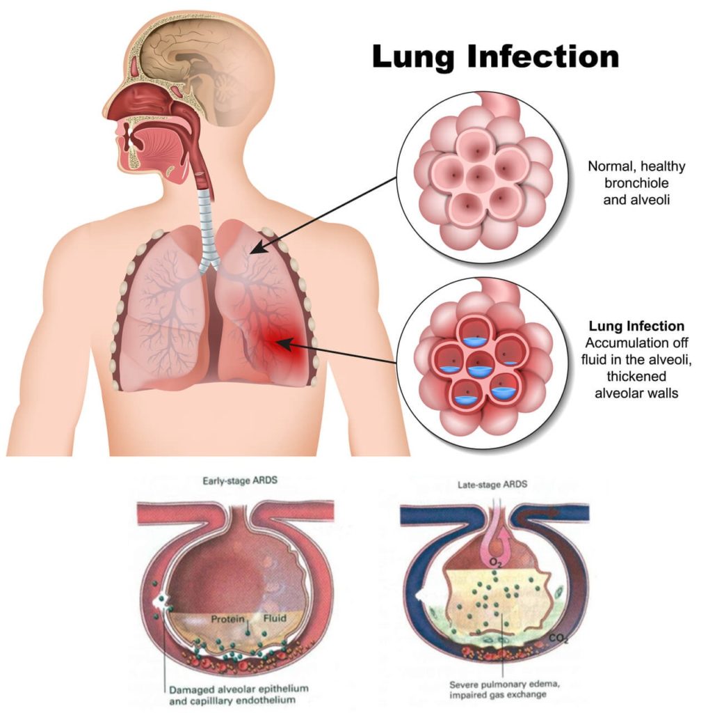 lungs filling with fluid as a result of the infection winning the battle.
